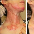 Mastering Chronic Wound Care Through the Hypertrophic Scar Healing Stages