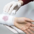 Effective Strategies For Managing Chronic Wounds: Excoriation Wound Vs Maceration Wound