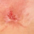 Identifying Wound Infection Symptoms for Effective Chronic Treatment Management