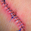 How Long Do Dissolvable Stitches Last? The Role of Proper Wound Treatment in Healing