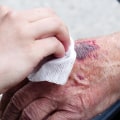 The Essential Guide to Wound Care for Caregivers