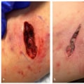 What You Need To Know About Types Of Skin Tunneling Wounds In Chronic Care