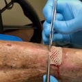 Managing Collagen Wound Dressing Side Effects For Better Chronic Wound Treatment Outcomes