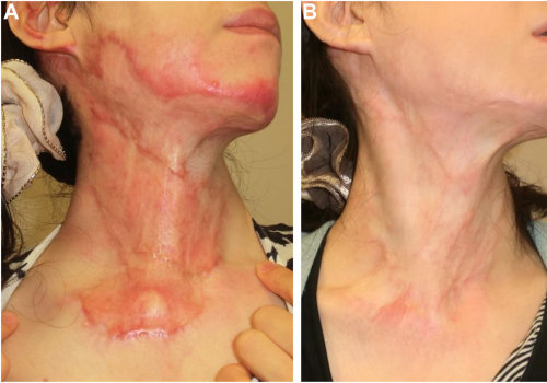 Mastering Chronic Wound Care Through the Hypertrophic Scar Healing Stages