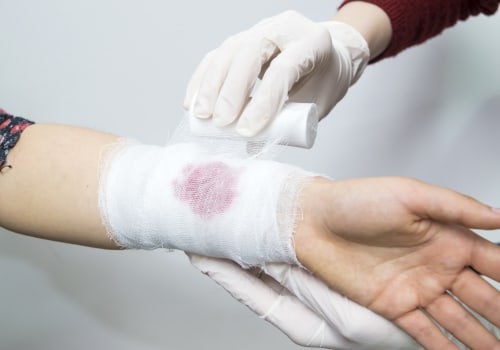 Effective Strategies For Managing Chronic Wounds: Excoriation Wound Vs Maceration Wound