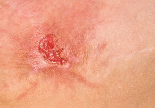 Identifying Wound Infection Symptoms for Effective Chronic Treatment Management