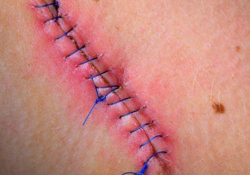 How Long Do Dissolvable Stitches Last? The Role of Proper Wound Treatment in Healing