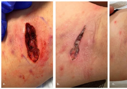 What You Need To Know About Types Of Skin Tunneling Wounds In Chronic Care